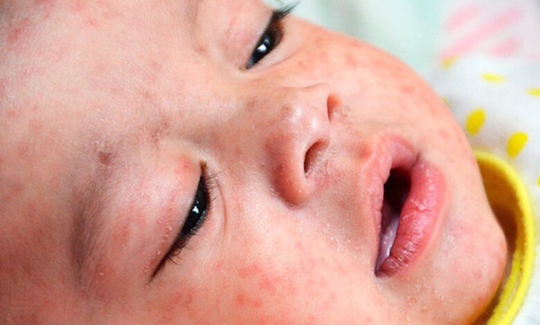 Measles outbreak in europe who ramps up vaccination campaign