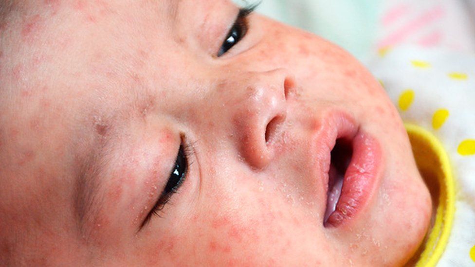 Measles outbreak in europe who ramps up vaccination campaign